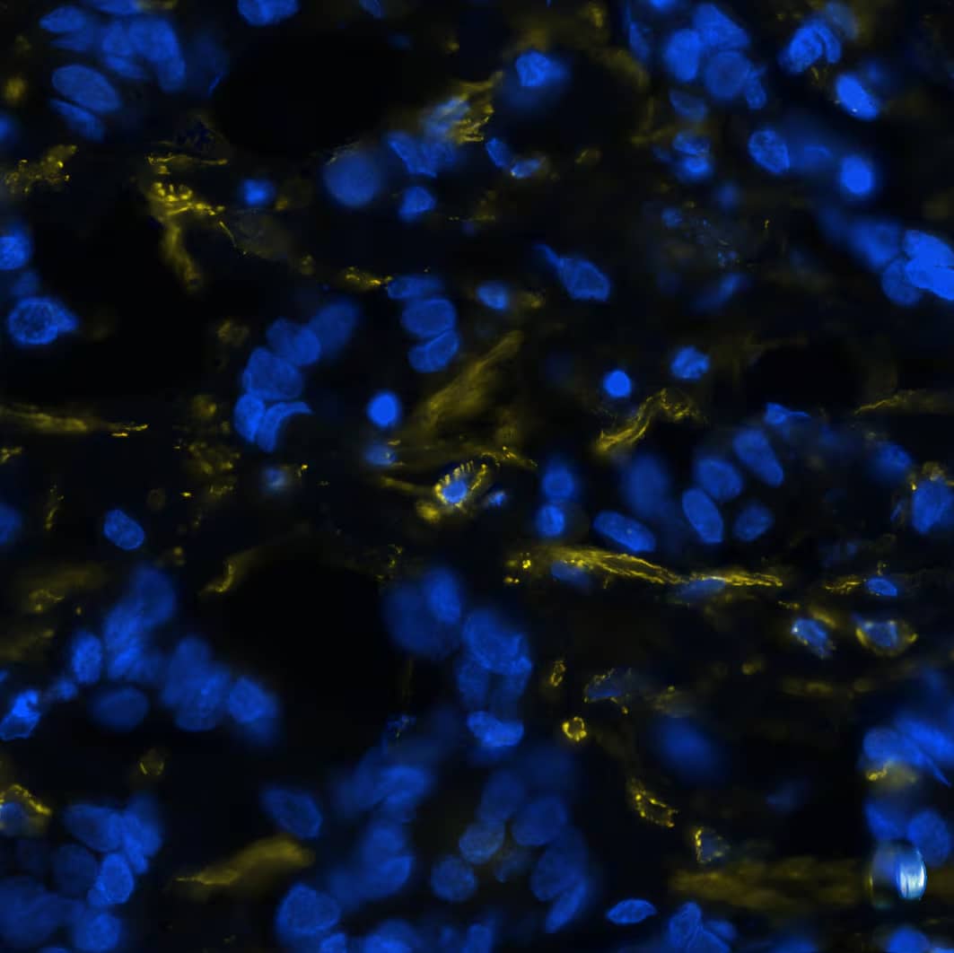  alpha -Smooth Muscle Actin was detected in immersion fixed paraffin-embedded sections of human breast cancer using Mouse Anti-Human/Mouse/Rat  alpha -Smooth Muscle Actin Monoclonal Antibody (Novus Catalog # NBP2-33006) at 0.25ug/mL at 37 ° Celsius for 2 minutes. Before incubation with the primary antibody, tissue underwent an all-in-one dewaxing and antigen retrieval preprocessing using PreTreatment Module (PT Module) and Dewax and HIER Buffer H (pH 9). Tissue was stained using the Alexa Fluor™ 555 Goat anti-Mouse IgG Secondary Antibody at 1:100 at 37 ° Celsius for 2 minutes. (Yellow; Lunaphore Catalog # DR555MS) and counterstained with DAPI (blue; Lunaphore Catalog # DR100). Specific staining was localized to the cytoplasm and cytoskeleton. Protocol available in COMET™ Panel Builder.